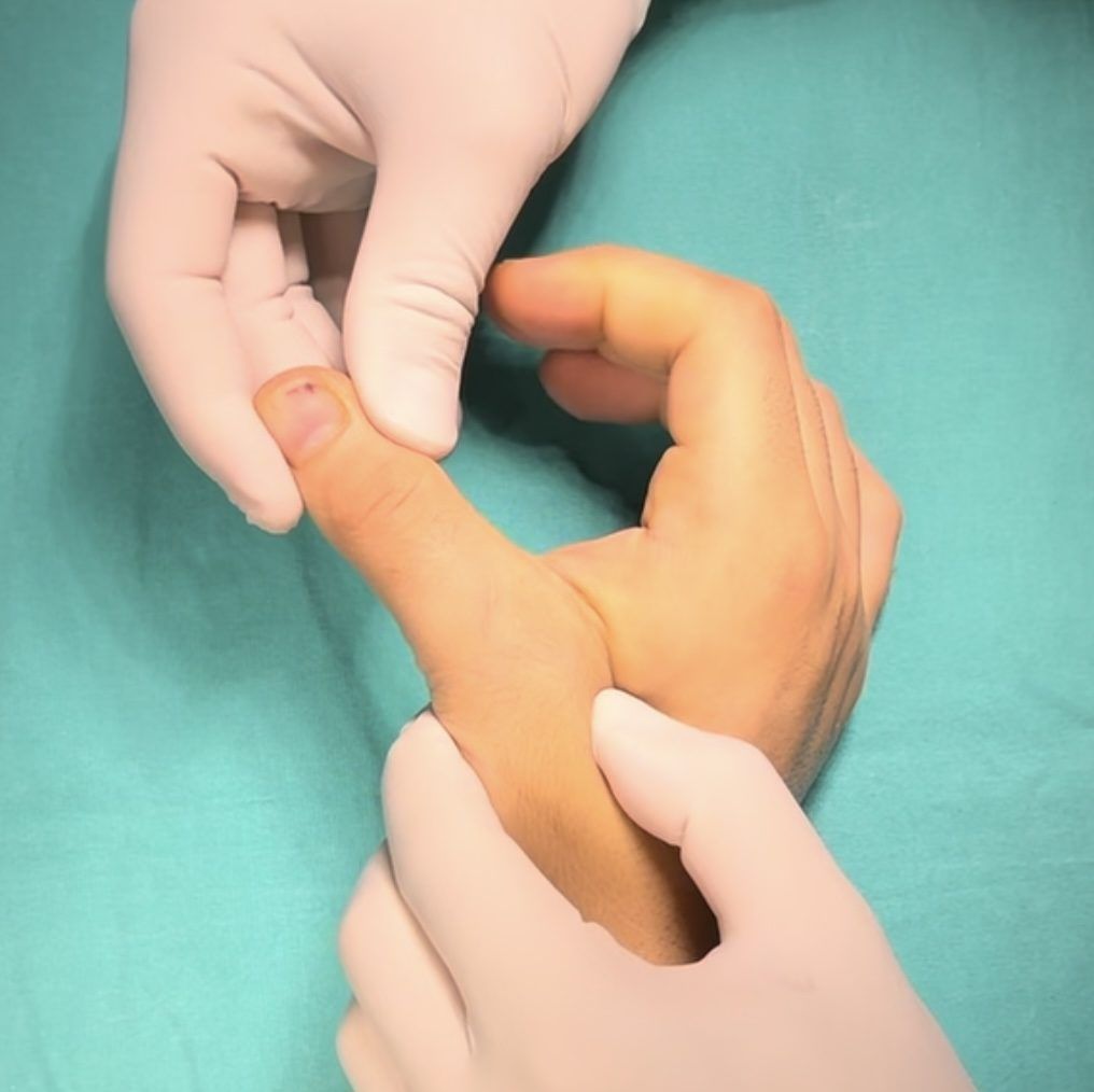 Kayakçı Başparmağı ( Ulnar Kollateral Bağ Yaralanması)