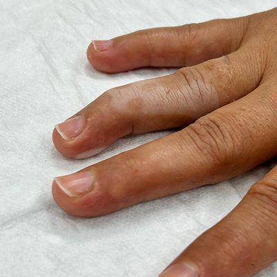 Çekiç parmak – Mallet Finger nedir?